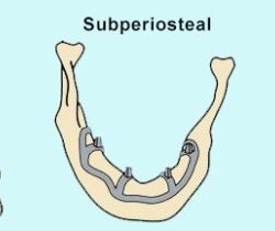 Cpt code for dental implant