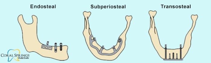 Cpt code for dental implant