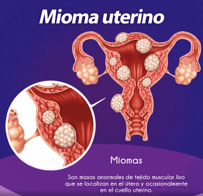 Los miomas producen mal olor